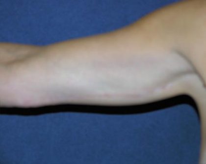 Arm Lift Before & After Patient #579