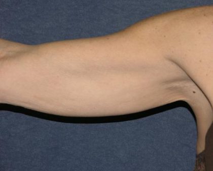 Arm Lift Before & After Patient #579