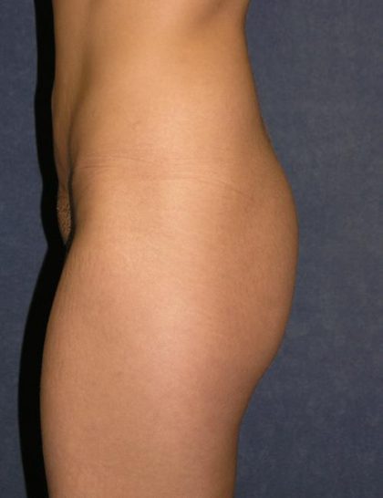 Buttock Lift Before & After Patient #582
