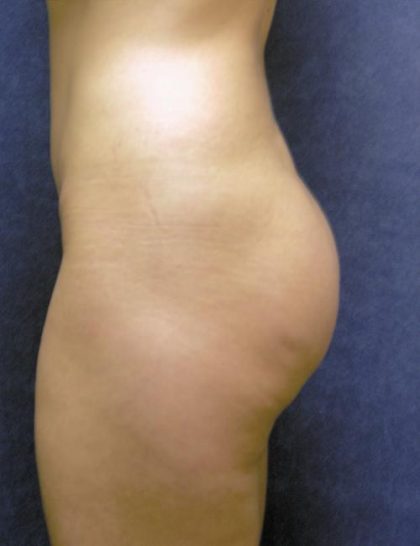 Buttock Lift Before & After Patient #582