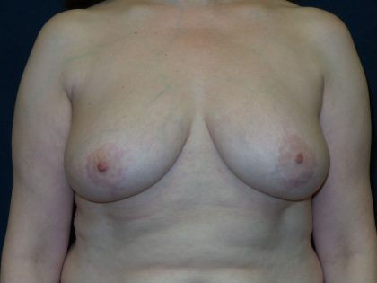Breast Reduction Before & After Patient #1414