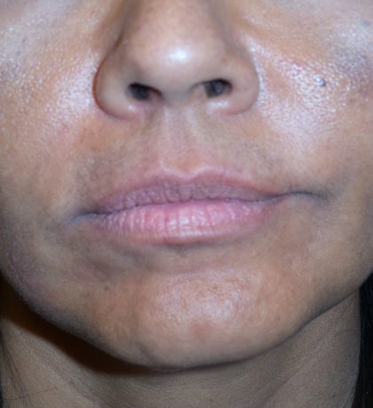 Dermal Fillers Before & After Patient #1798