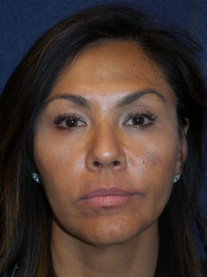 Dermal Fillers Before & After Patient #1798