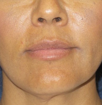 Dermal Fillers Before & After Patient #1798