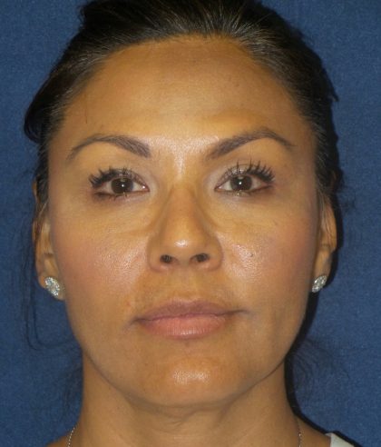 Dermal Fillers Before & After Patient #1798